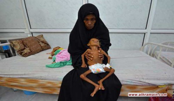 منسق العمليات الانسانية في الأمم المتحدة يعرب عن “احباطه العميق” لرؤية الأطفال في اليمن يعانون من سوء التغذية جراء الحرب