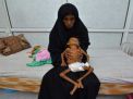 منسق العمليات الانسانية في الأمم المتحدة يعرب عن “احباطه العميق” لرؤية الأطفال في اليمن يعانون من سوء التغذية جراء الحرب