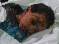 صعدة: استشهاد طفل وإصابة شقيقه بانفجار قنبلة عنقودية سعودية